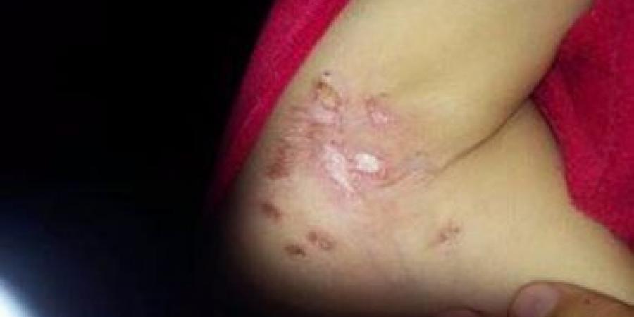 بالفيديو.. حرق طفلة بالسجائر والماء المغلي على يد زوج أمها