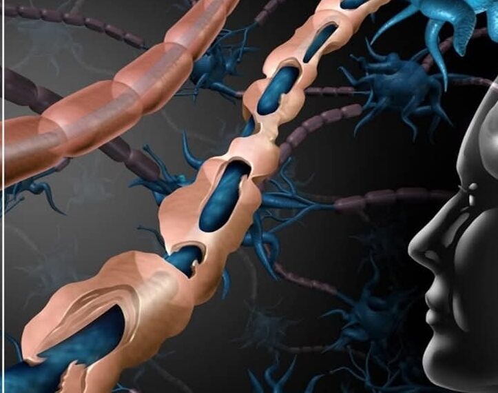 مرض التصلب المتعدد MS